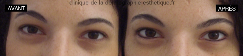 Maquillage permanent Khôl (Permanent make-up - Eyeliner - Khôl)