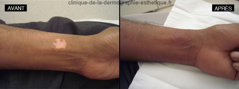 Dermographie réparatrice - Vitiligo