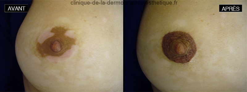 Dermographie réparatrice - Vitiligo (Corrective dermography - Vitiligo)